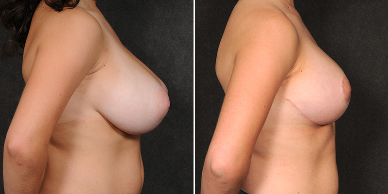 Dr. Kao Breast Reduction