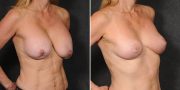 Implant Removal with Breast Lift