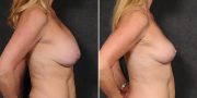 Implant Removal with Breast Lift