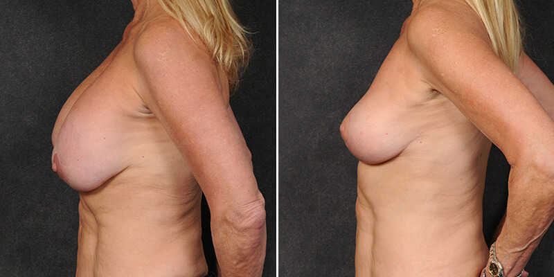 Implant Removal with Breast Lift