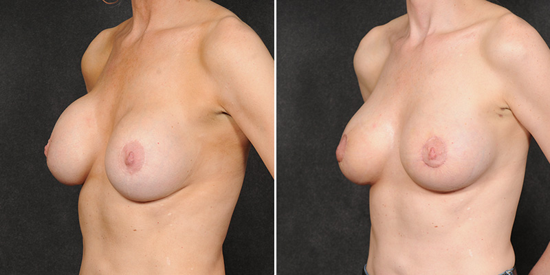 Dr. Kao Breast Implant Revision