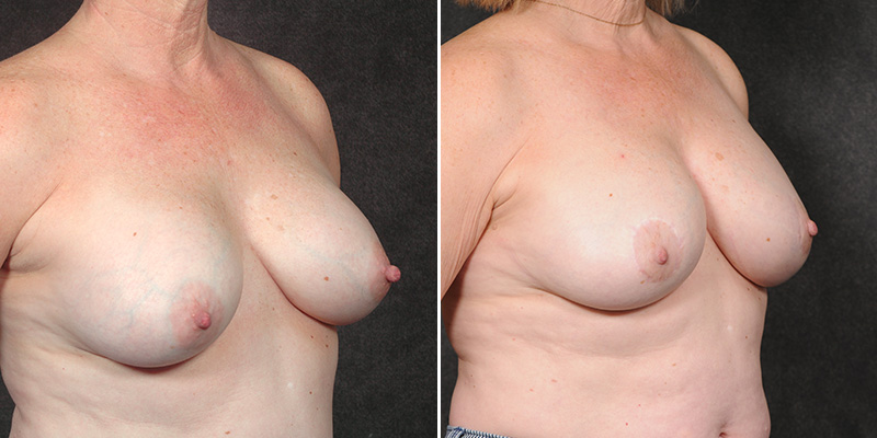 Dr. Kao Breast Implant Revision