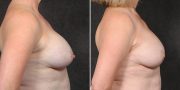 Dr. Kao Breast Implant Revision