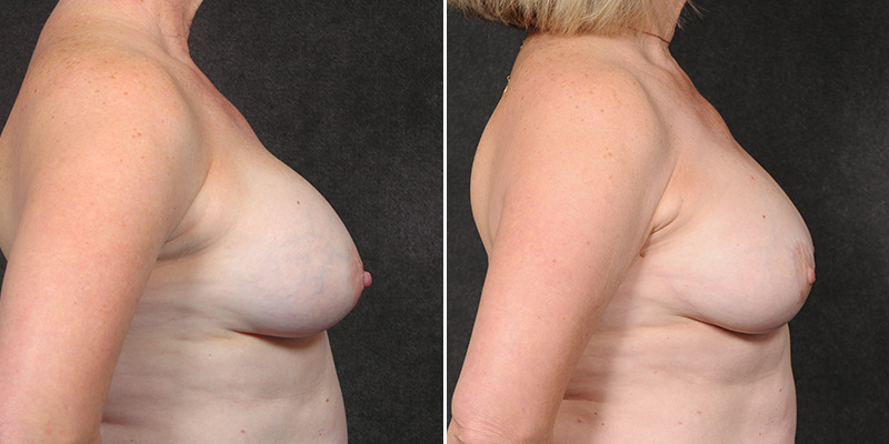 Dr. Kao Breast Implant Revision