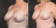 Dr. Kao Breast Implant Revision