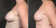 Dr. Kao Breast Implant Revision