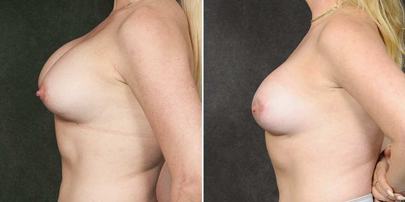 Dr. Kao Breast Implant Revision