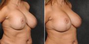 Dr. Kao Breast Implant Revision