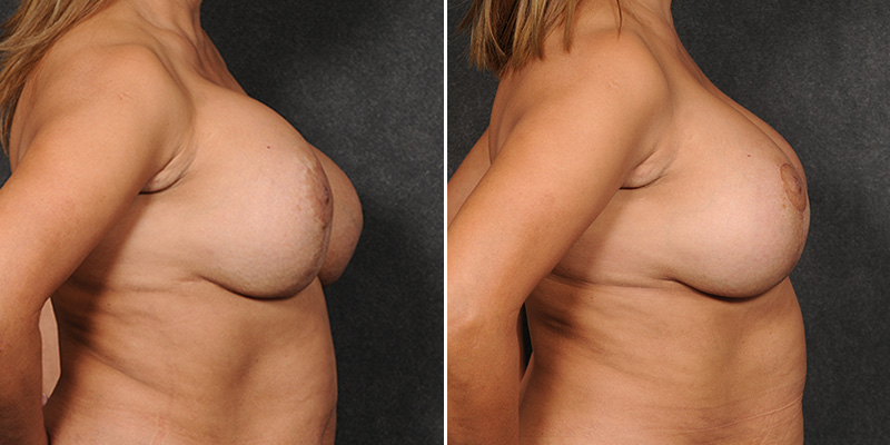 Dr. Kao Breast Implant Revision