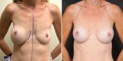 Dr. Kao Breast Implant Revision