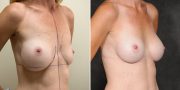 Dr. Kao Breast Implant Revision