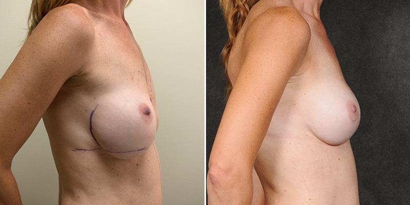 Dr. Kao Breast Implant Revision