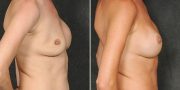 Dr. Kao Breast Implant Revision