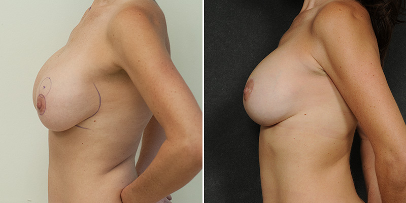 Breast Lift (Mastopexy) with Implant