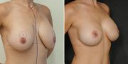 Breast Lift (Mastopexy) with Implant