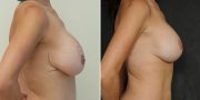 Breast Lift (Mastopexy) with Implant