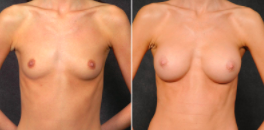 Kao Breast Augmentation Patient