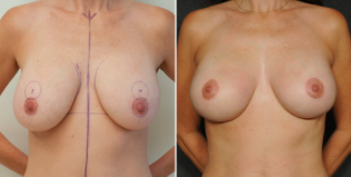 Internal Bra Mastopexy