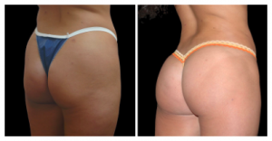 Brazilian Butt Lift Patient by Dr. Kao