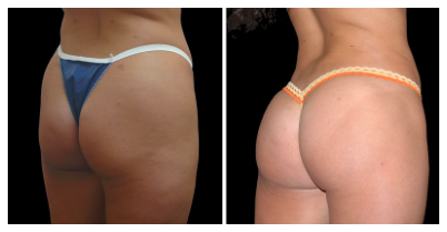 The Pros & Cons Of A Brazilian Butt Lift