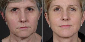 Ponytail Facelift™ Patient Results