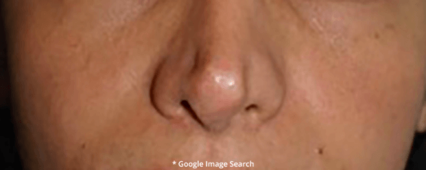 Nasal Tip