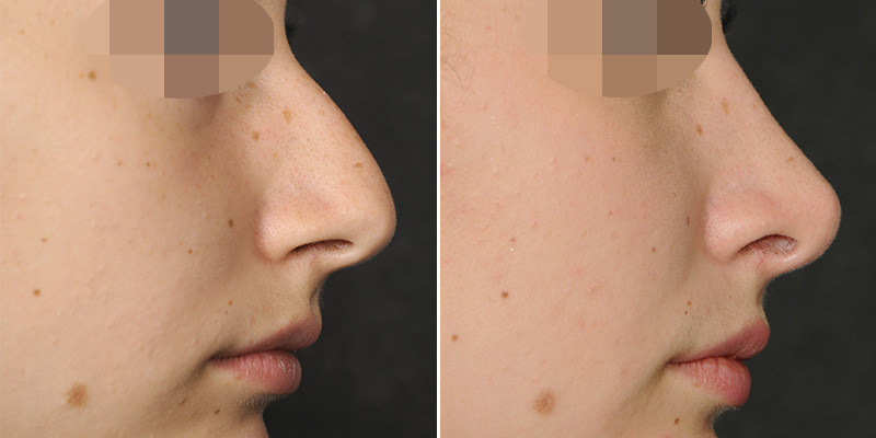 Rhinoplasty before and after