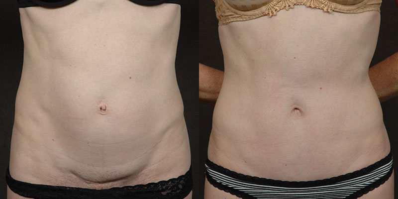 What Happens To My Belly Button During a Tummy Tuck? - Brown