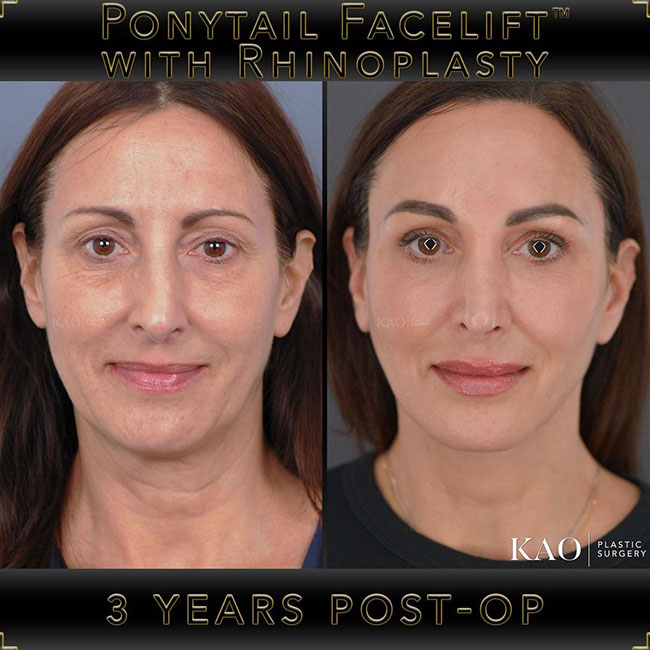 Kao Patients Results
