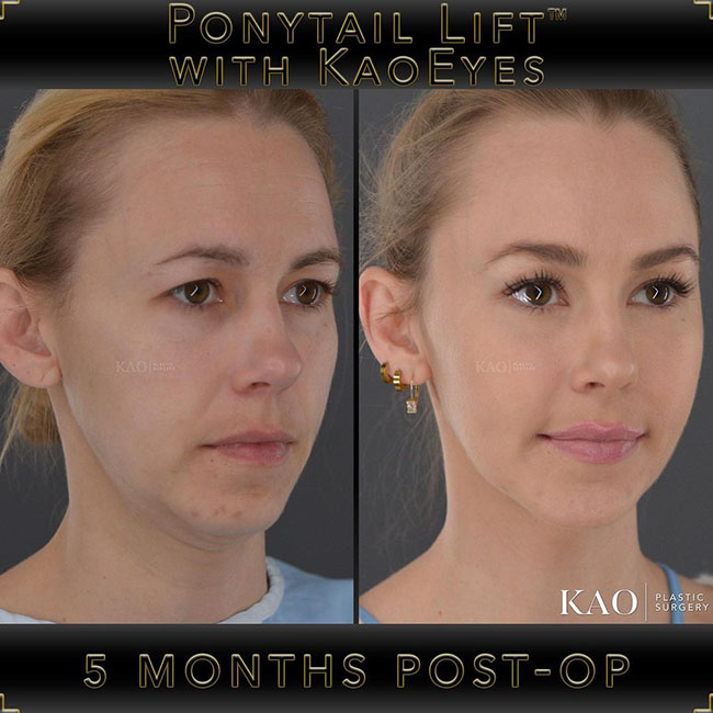 Kao Patients Results