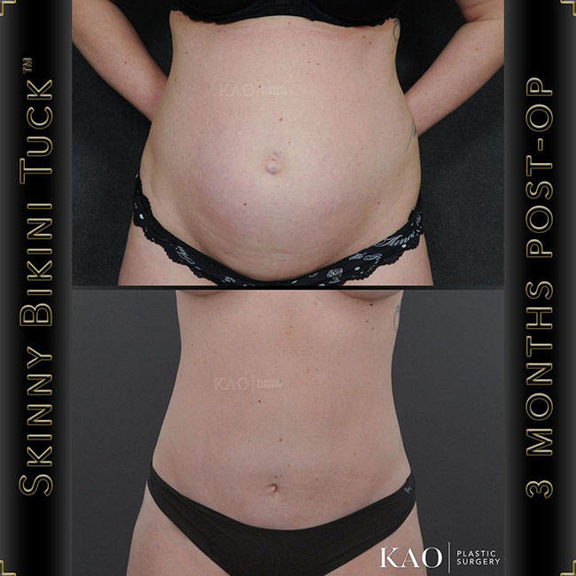 Kao Patients Results