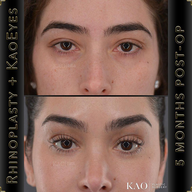Rhinoplasty + KAO Eyes Patient Results