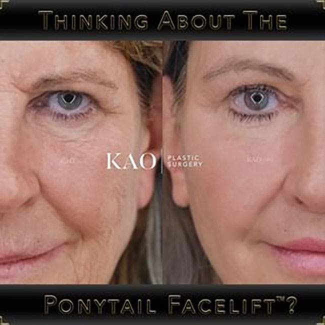 Ponytail Facelift Patient Results