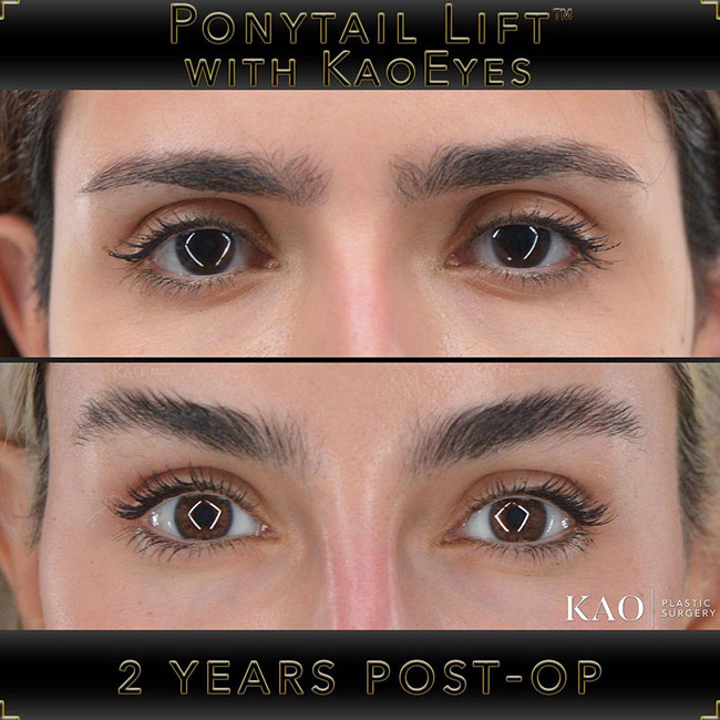 Ponytail Lift + KAO Eyes Patient Results