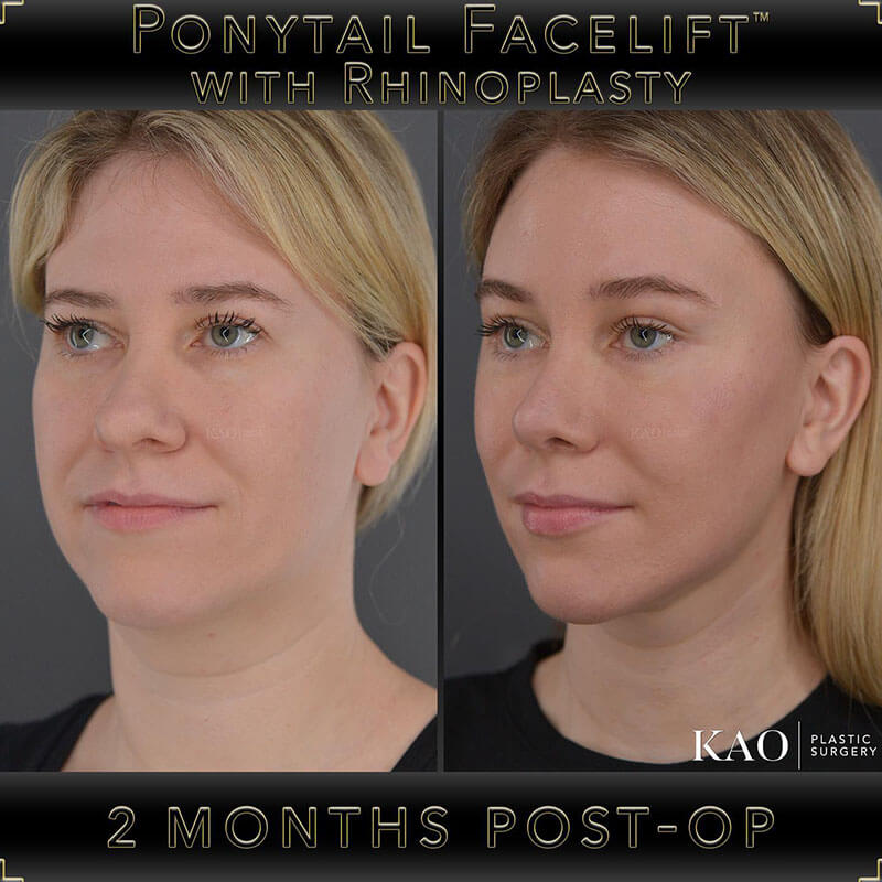 Before and After Results Ponytail Facelift