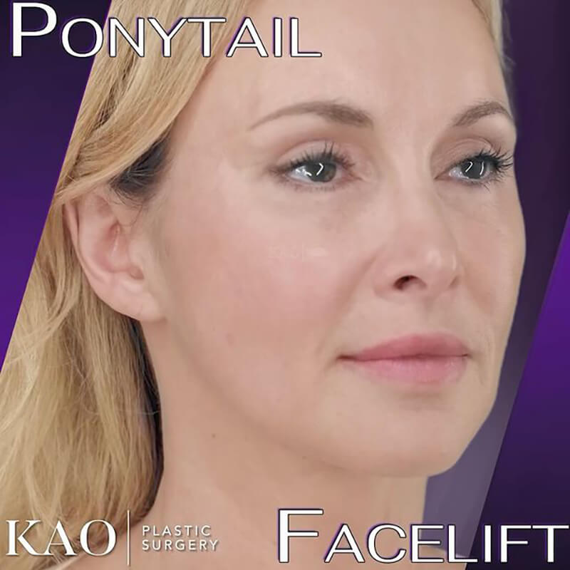 Ponytail Facelift Results
