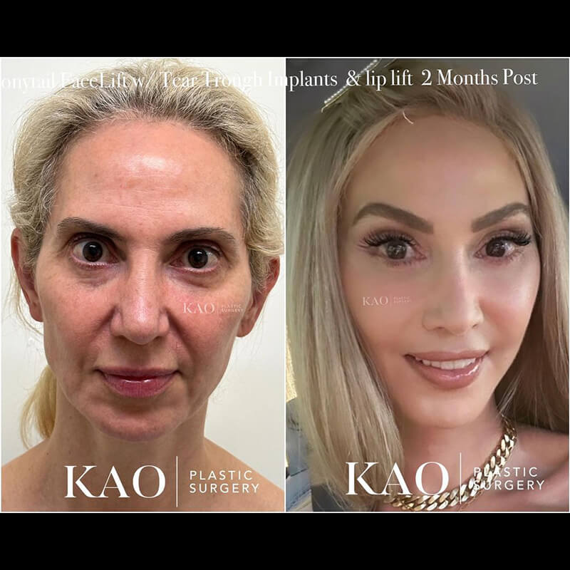 Before and After Results