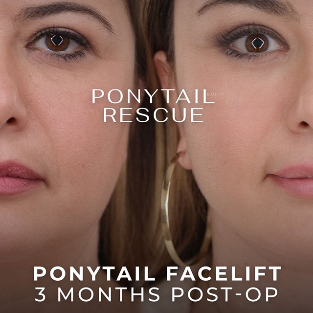 Before and after patient results
